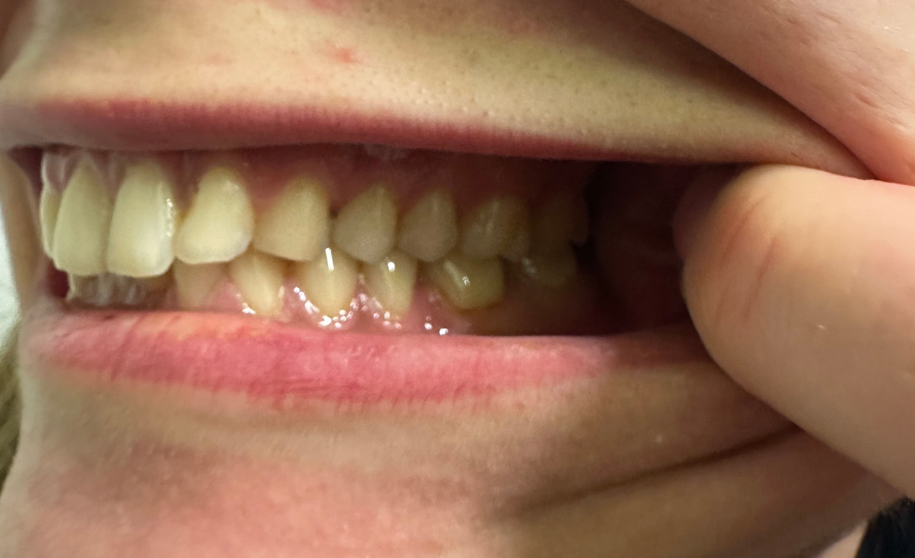 Left side bite photo example