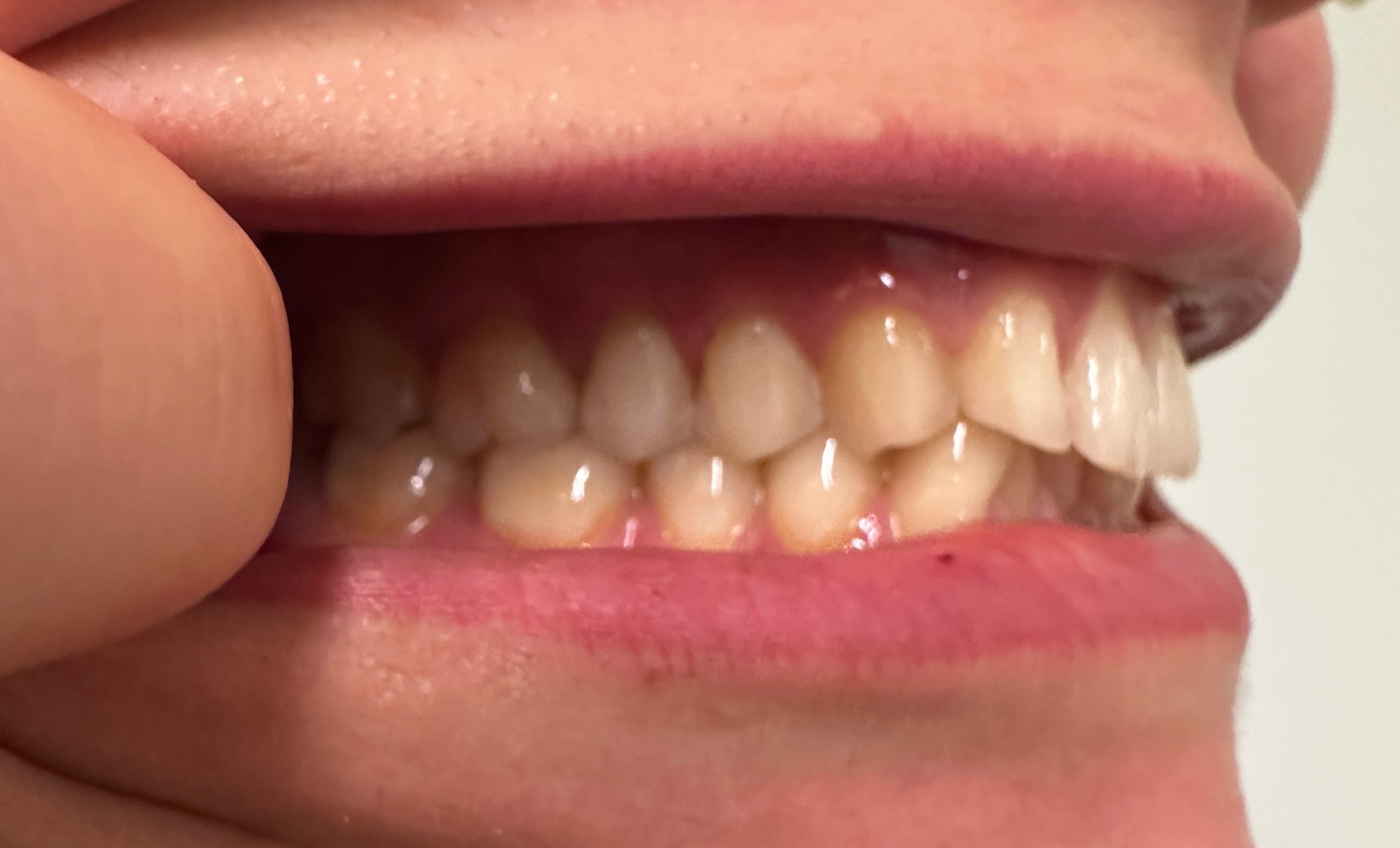 Right side bite photo example