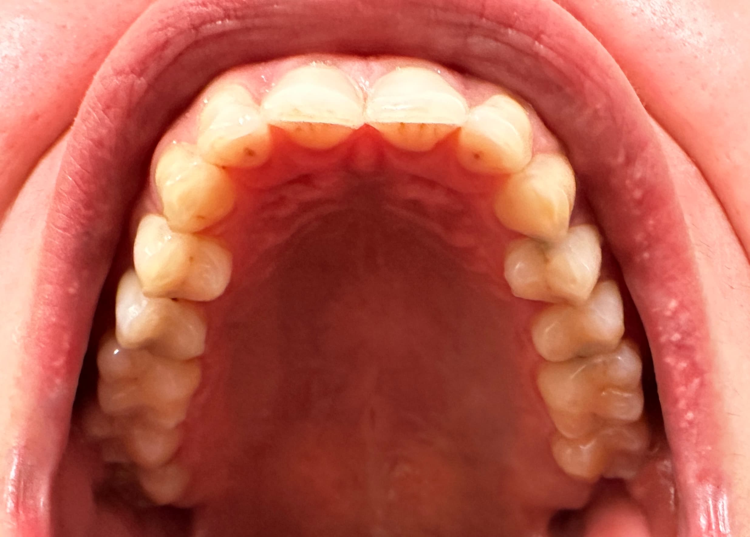 Upper teeth photo example